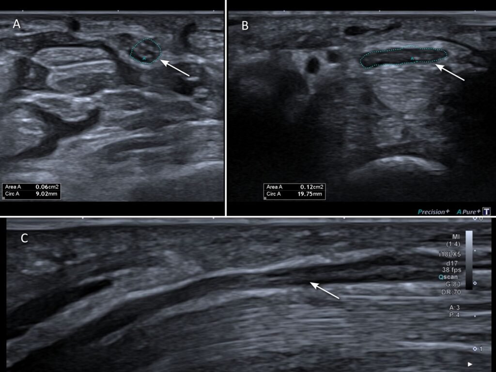 Ultrasound scan demonstrating median nerve impingement in a patient with carpal tunnel syndrome. 
