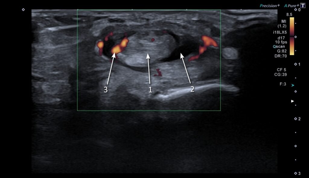 Tibialis posterior tendinitis and tenosynovitis.